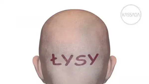 Kassada - Łysy