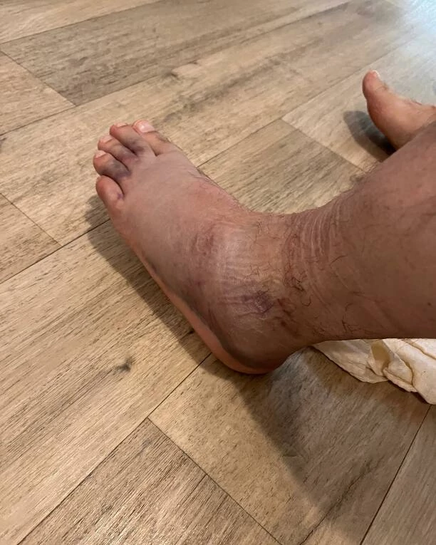 Dramat Marcina Millera Boys! Artysta pokazał zmasakrowaną nogę! Fani „Współczuję, zdrowiej nam„ 